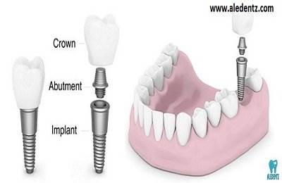 Dental Implants