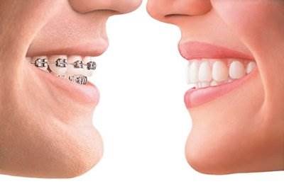 Orthodontics treatment