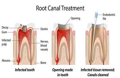 Root Canal Treatment