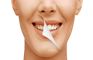Cosmetic Smile Makeover treatment at Aledentz Dental Clinic, Delhi