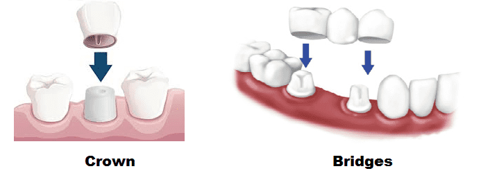 Crowns & Bridges