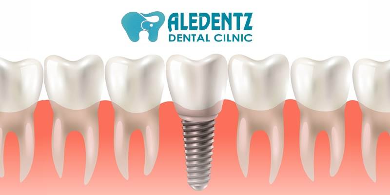 Root Canal Treatment(RCT)