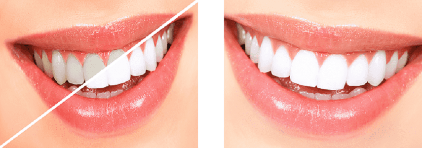 Teeth Whitening