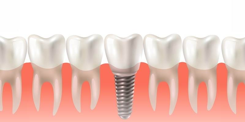 Dental Implants