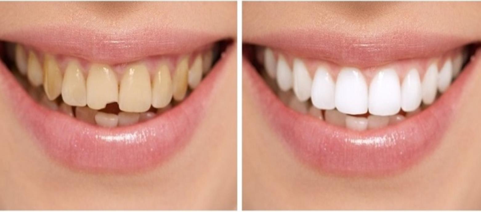 Smile Makeover in Uttam Nagar & Mahavir Enclave - Aledentz Dental Clinic, Delhi