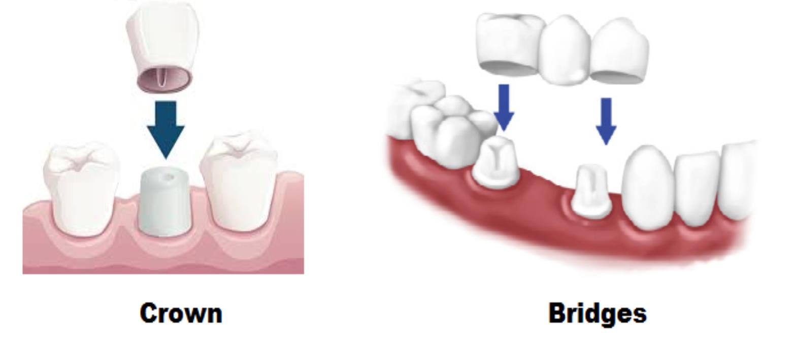 Crowns & Bridges in Uttam Nagar & Mahavir Enclave - Aledentz Dental Clinic, Delhi