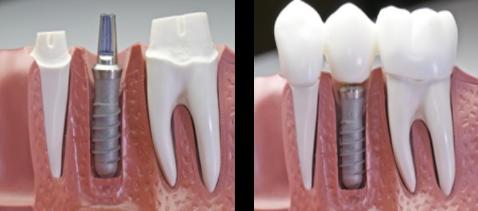 Orthodontic Treatments in Uttam Nagar & Mahavir Enclave - Aledentz Dental Clinic, Delhi