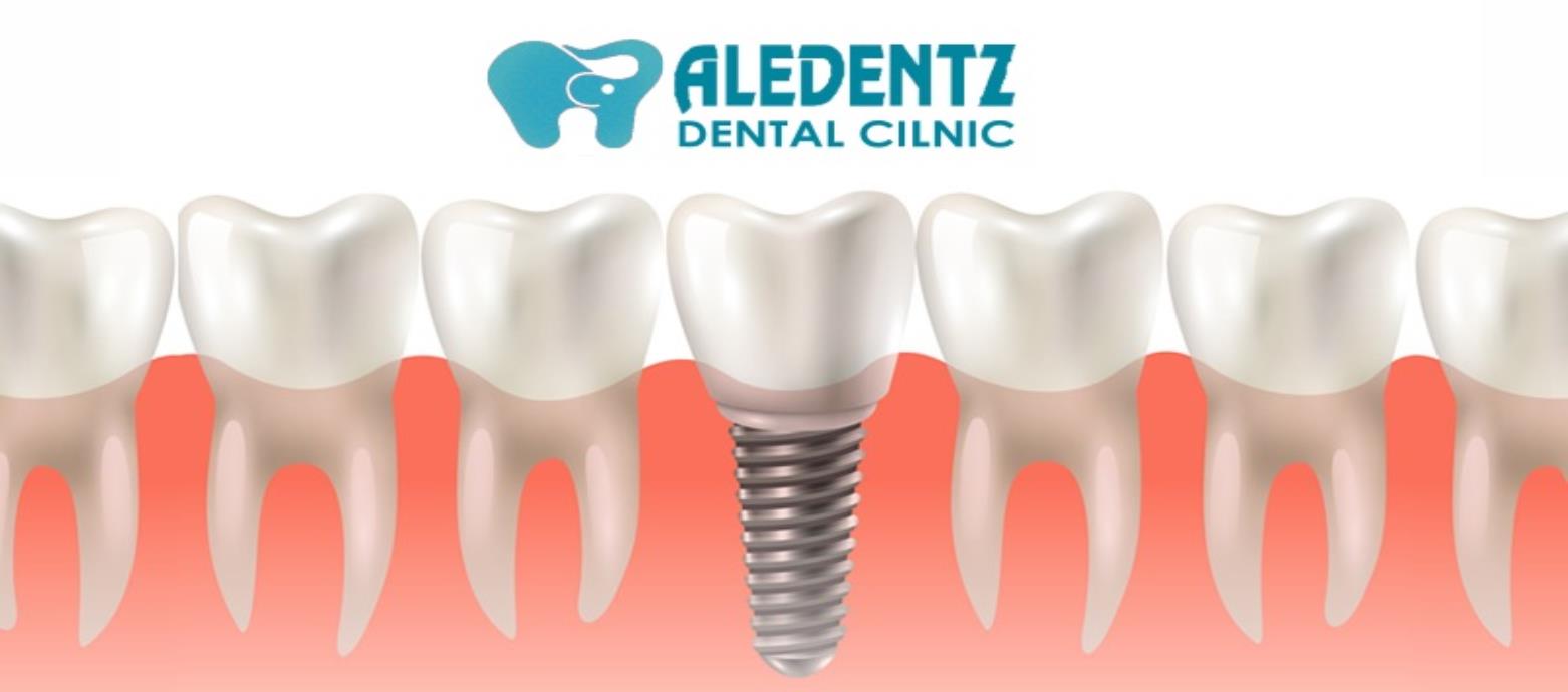 Root Canal Treatment (RCT) in Uttam Nagar & Mahavir Enclave - Aledentz Dental Clinic, Delhi