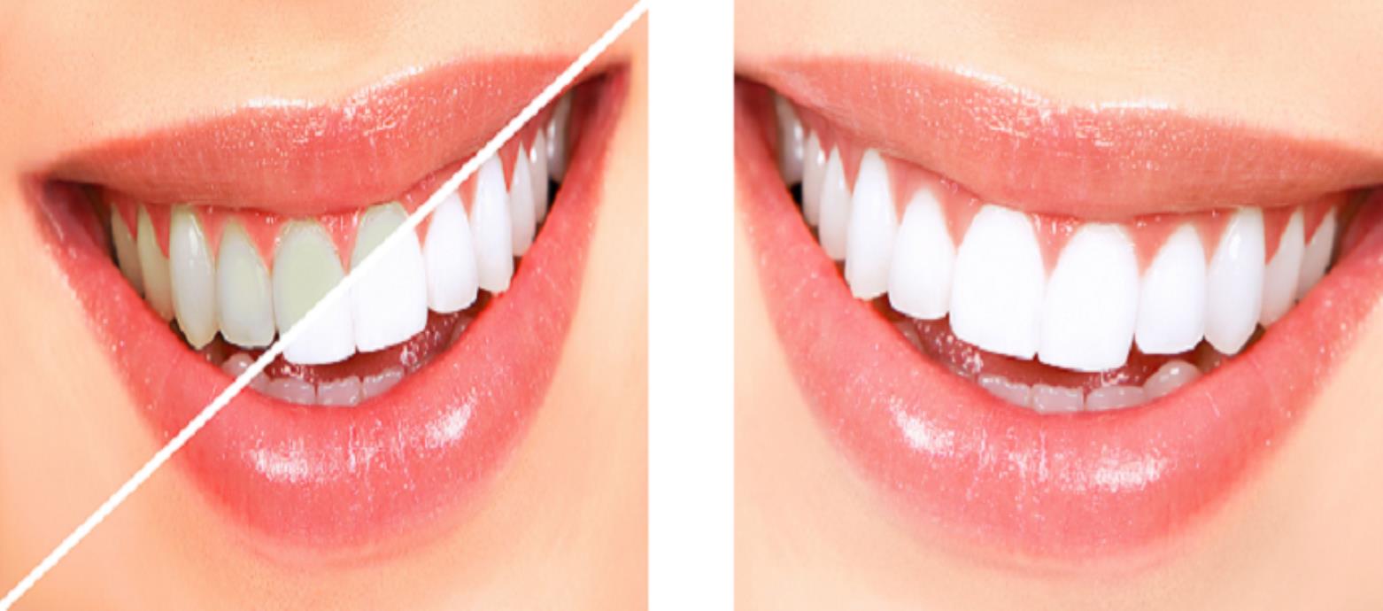 Teeth Whitening in Uttam Nagar & Mahavir Enclave - Aledentz Dental Clinic, Delhi