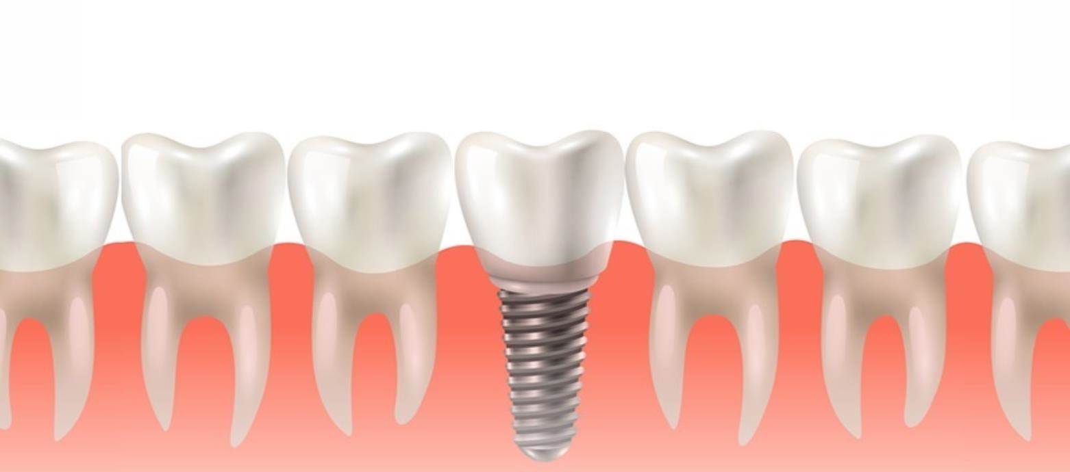 Dental Implants in Uttam Nagar & Mahavir Enclave - Aledentz Dental Clinic, Delhi