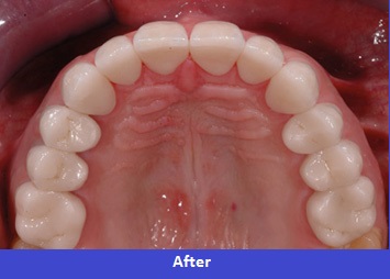 dental implants after