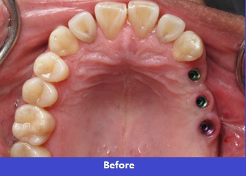 dental implants before